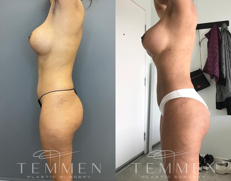 Skinny Brazilian Butt Lift Before & After