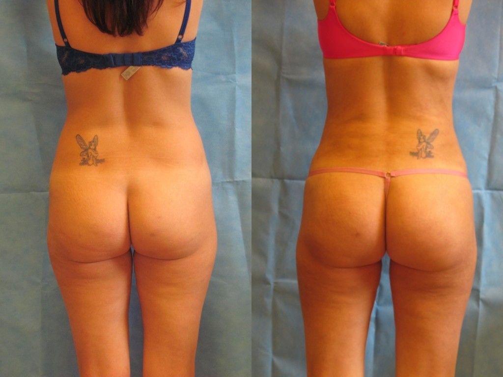 Skinny Brazilian Butt Lift Before & After