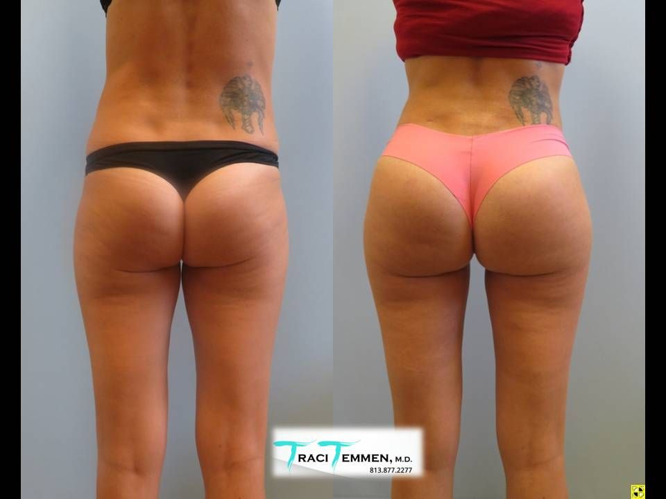 Skinny Brazilian Butt Lift Before & After
