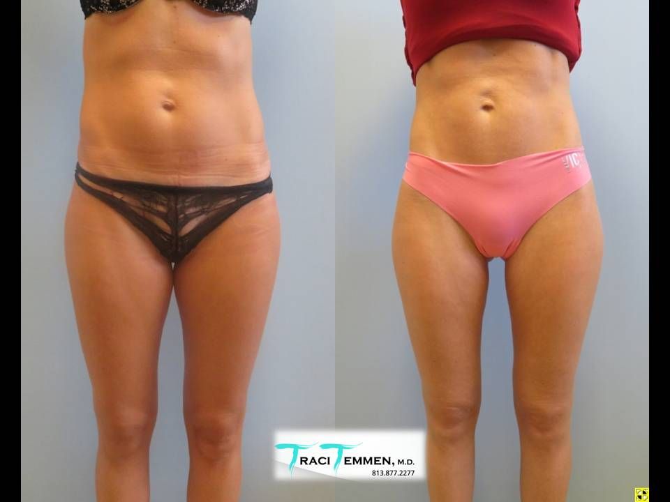 Skinny Brazilian Butt Lift Before & After