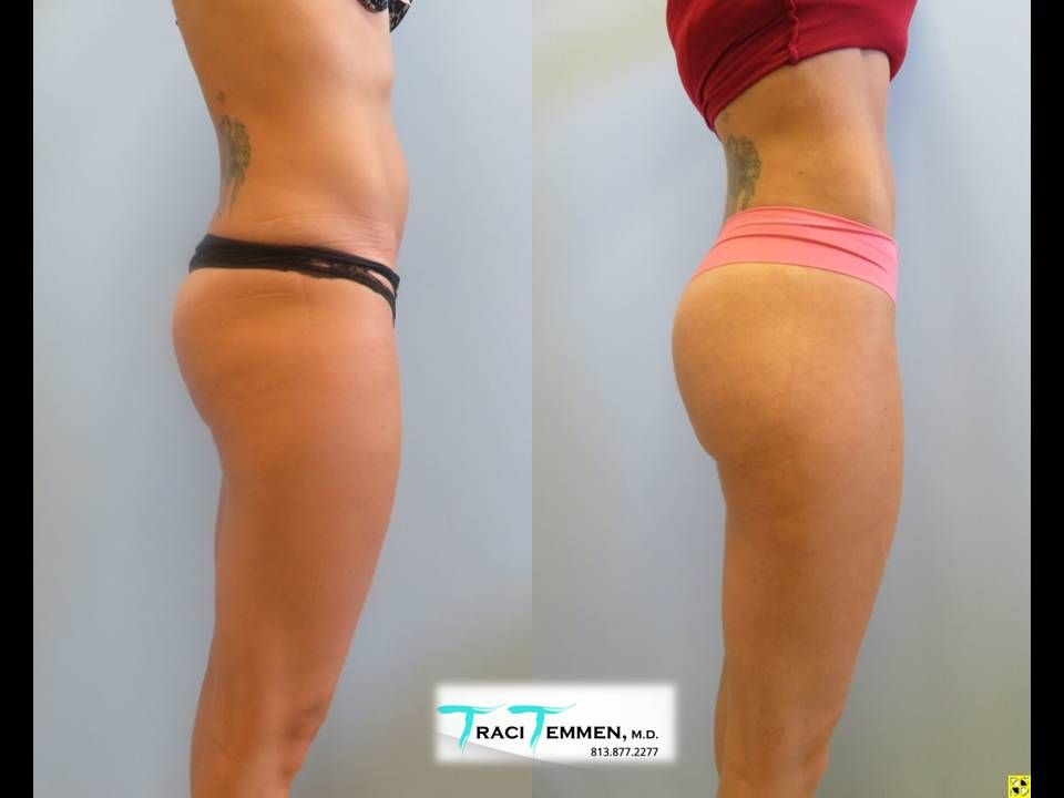 Skinny Brazilian Butt Lift Before & After