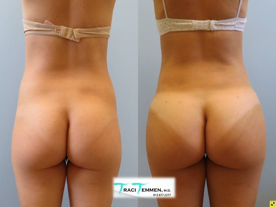 Skinny Brazilian Butt Lift Before & After