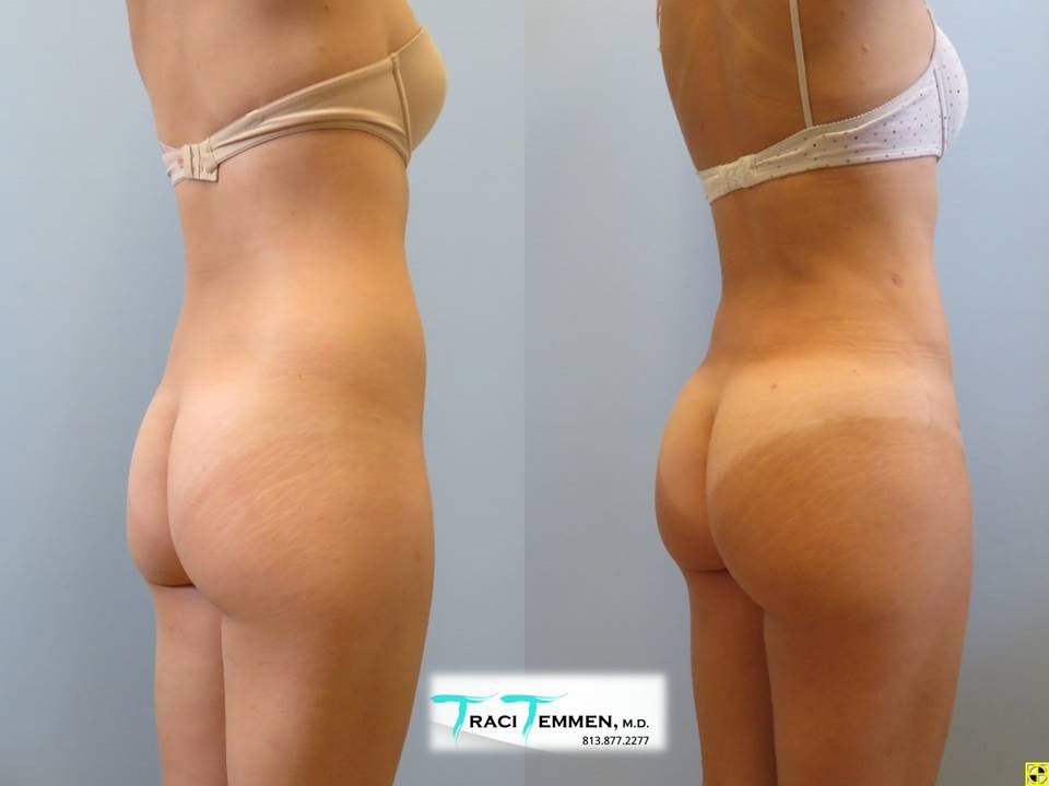 Skinny Brazilian Butt Lift Before & After