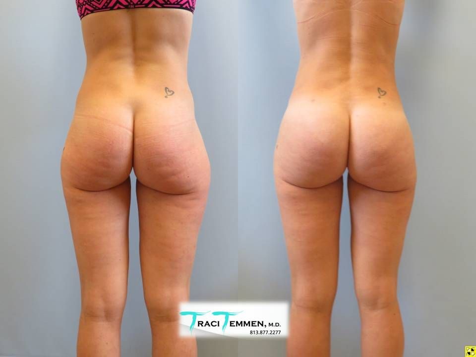 Skinny Brazilian Butt Lift Before & After