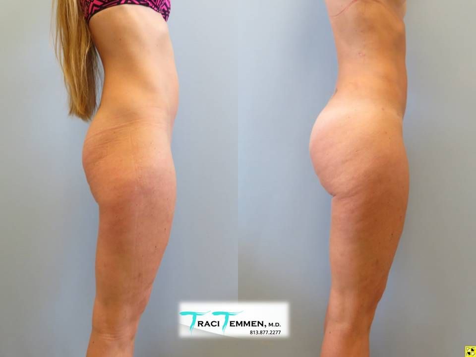 Skinny Brazilian Butt Lift Before & After