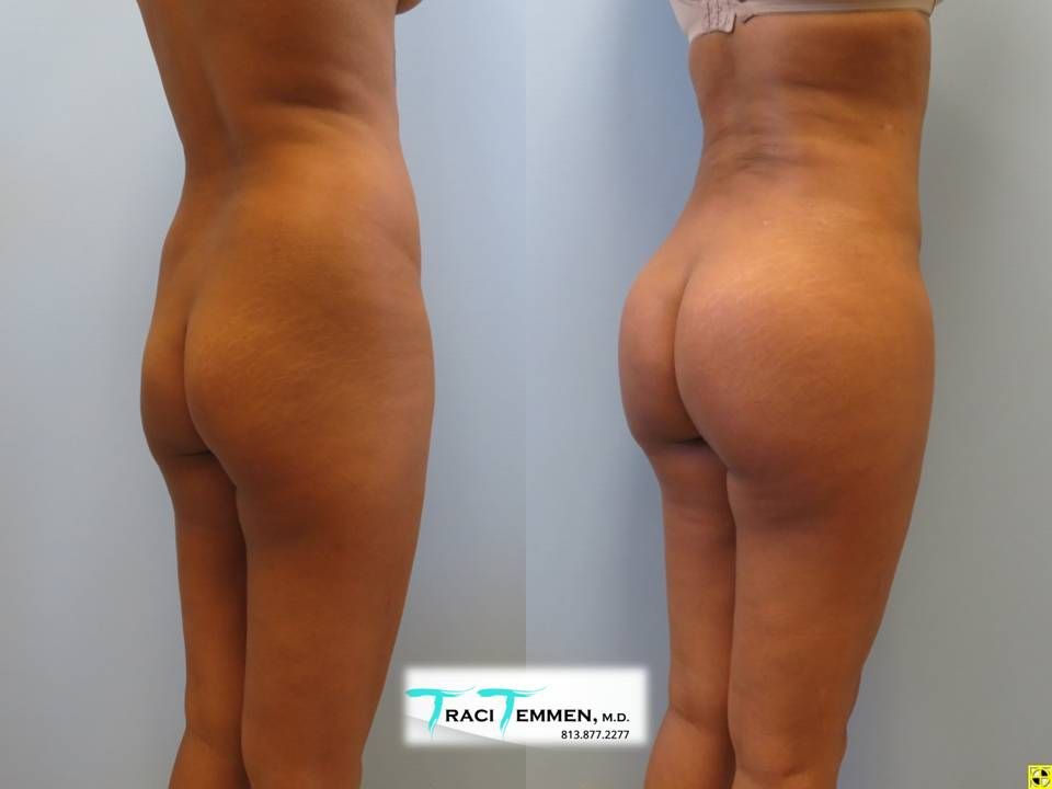Skinny Brazilian Butt Lift Before & After
