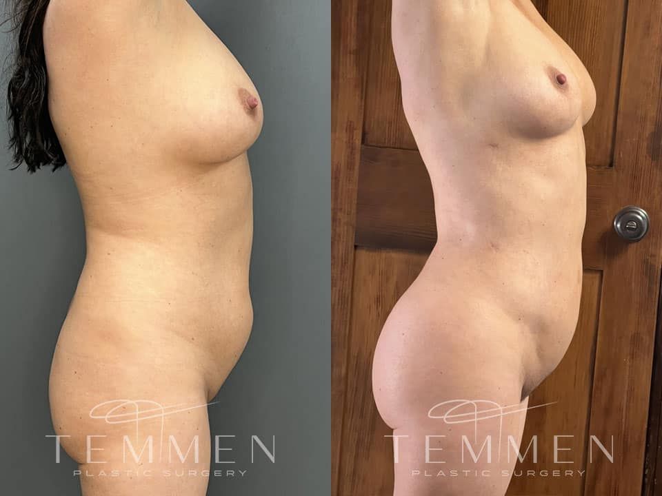 Skinny Brazilian Butt Lift Before & After