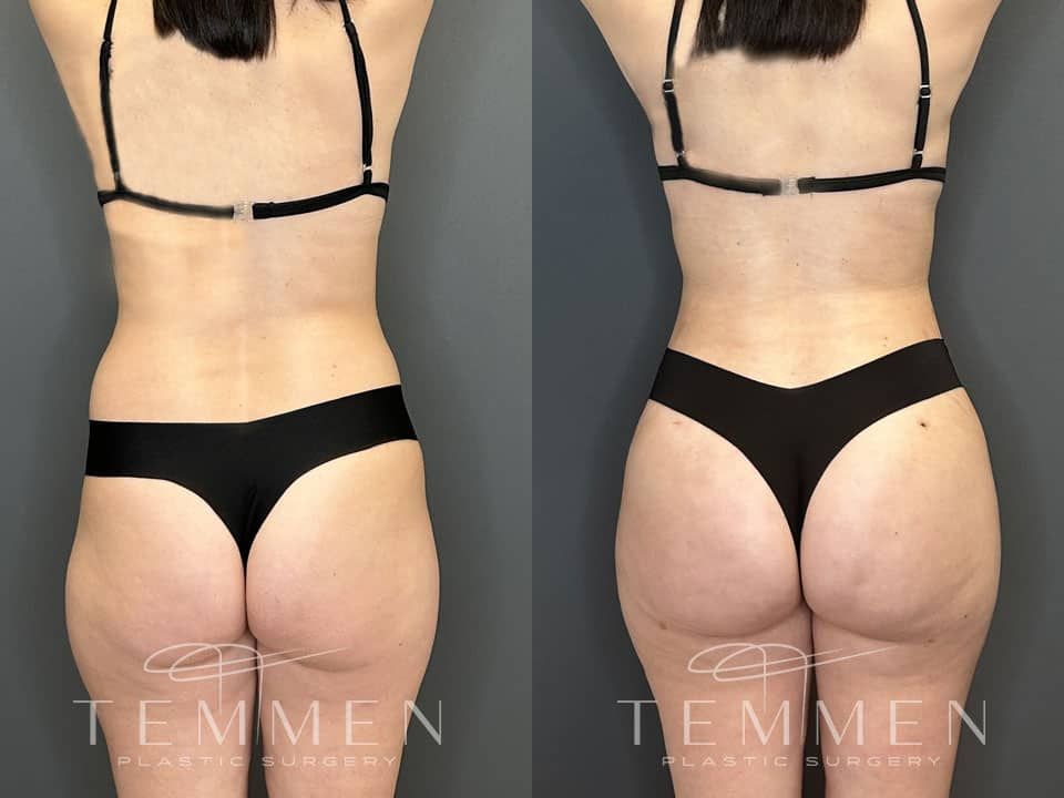 Skinny Brazilian Butt Lift Before & After