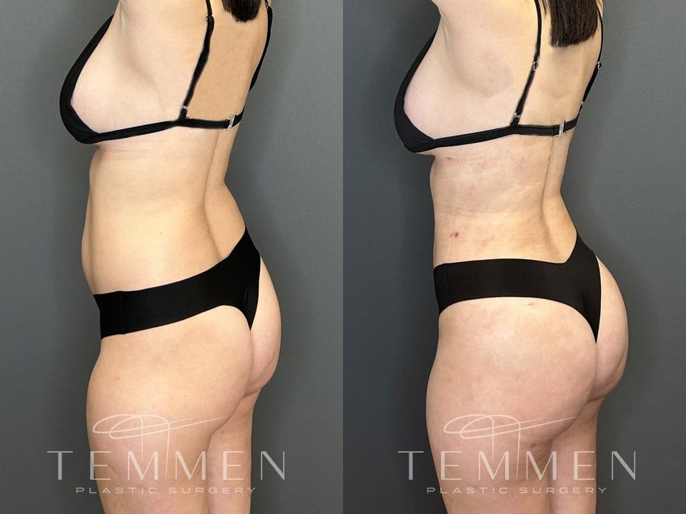 Skinny Brazilian Butt Lift Before & After