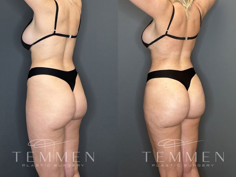 Skinny Brazilian Butt Lift Before & After