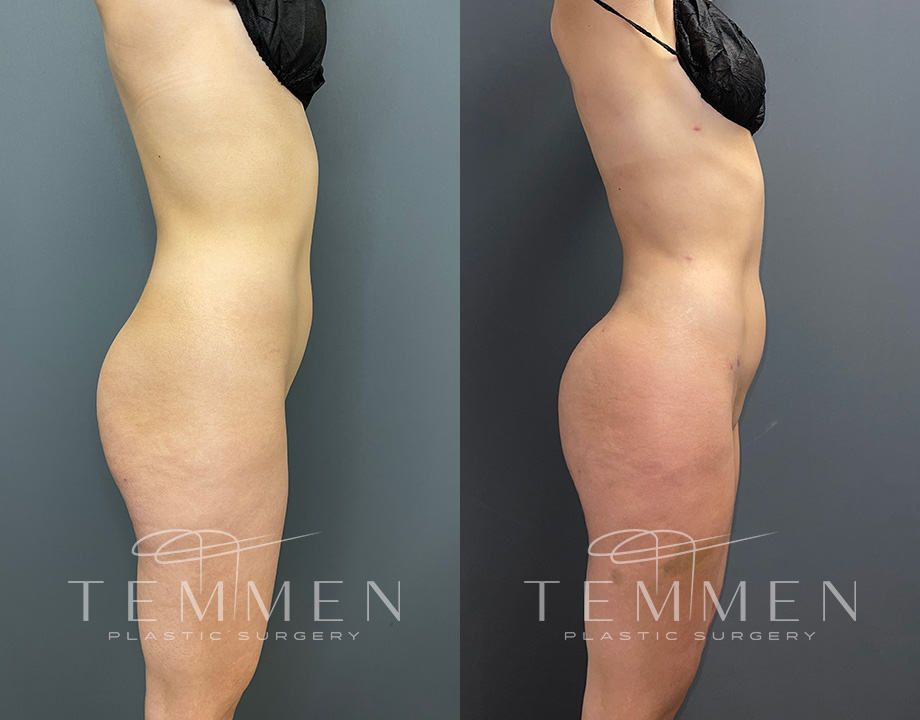 Skinny Brazilian Butt Lift Before & After