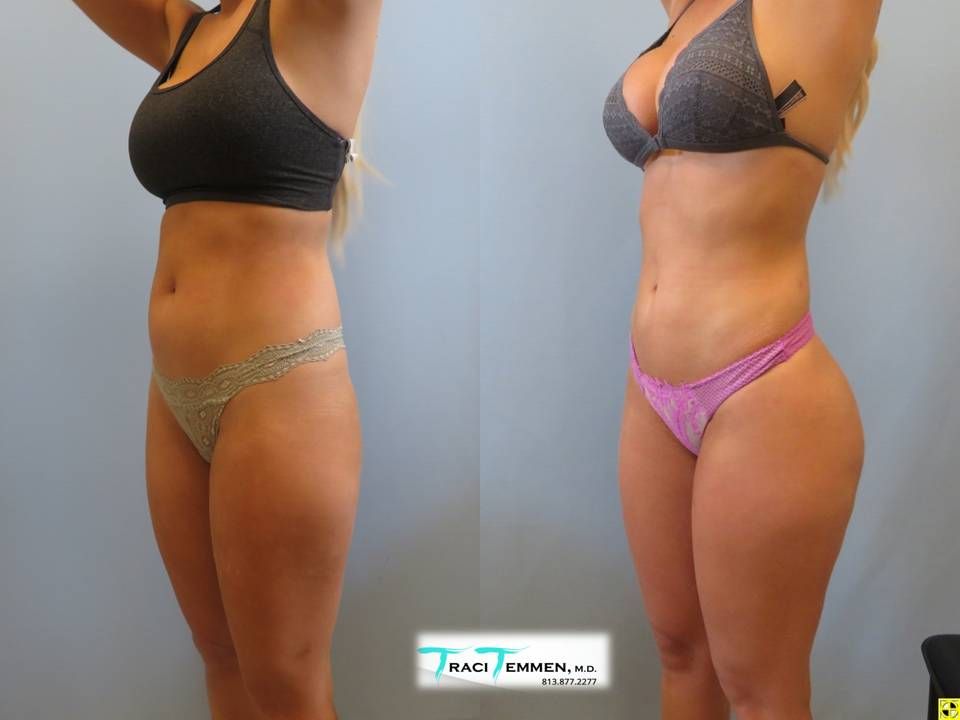 Skinny Brazilian Butt Lift Before & After