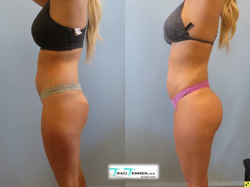 Skinny Brazilian Butt Lift Before & After