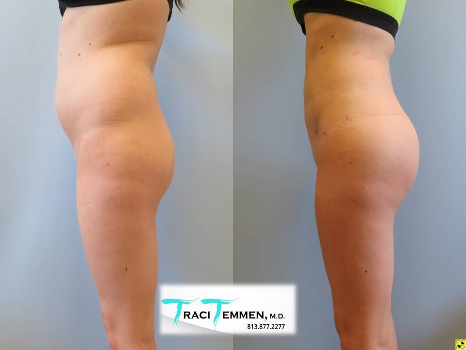 Skinny Brazilian Butt Lift Before & After