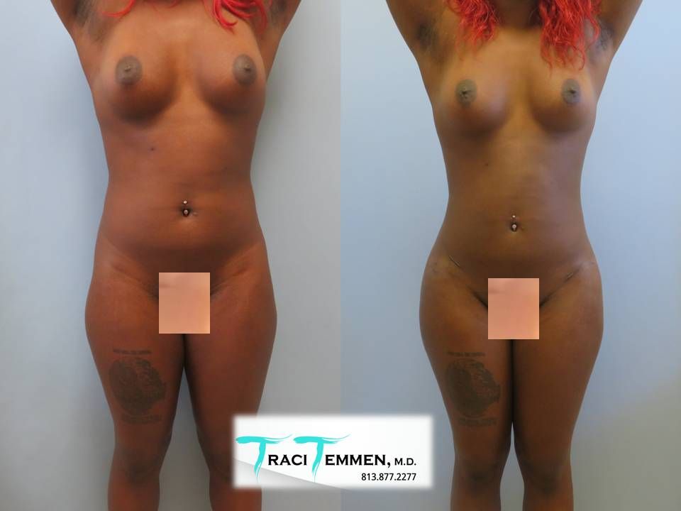 Skinny Brazilian Butt Lift Before & After