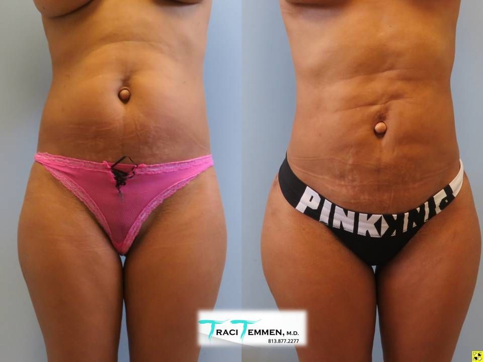 Skinny Brazilian Butt Lift Before & After