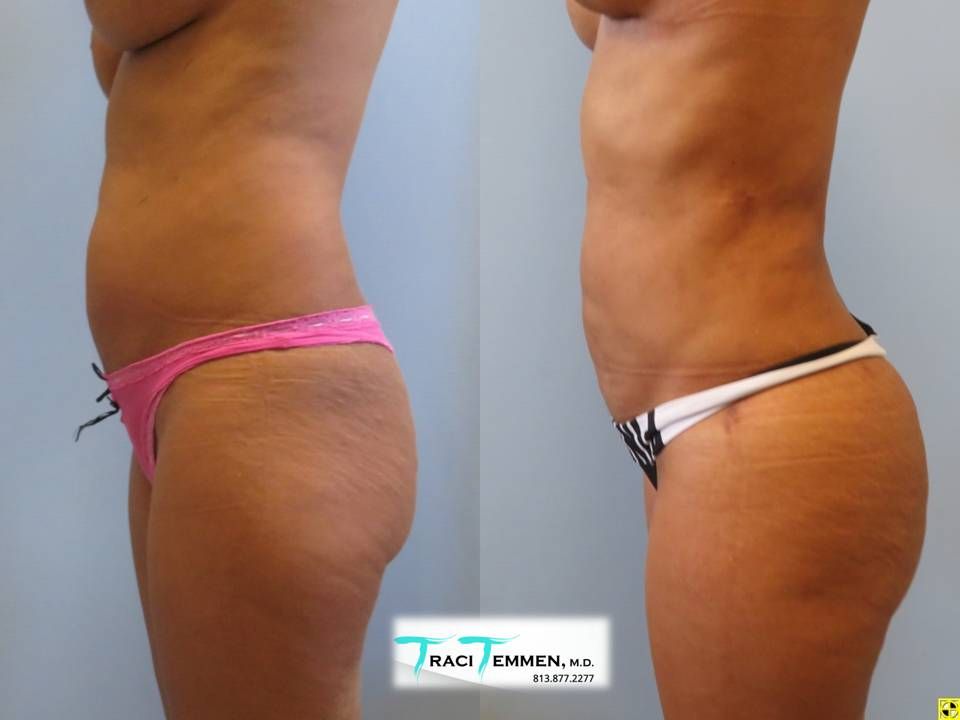 Skinny Brazilian Butt Lift Before & After