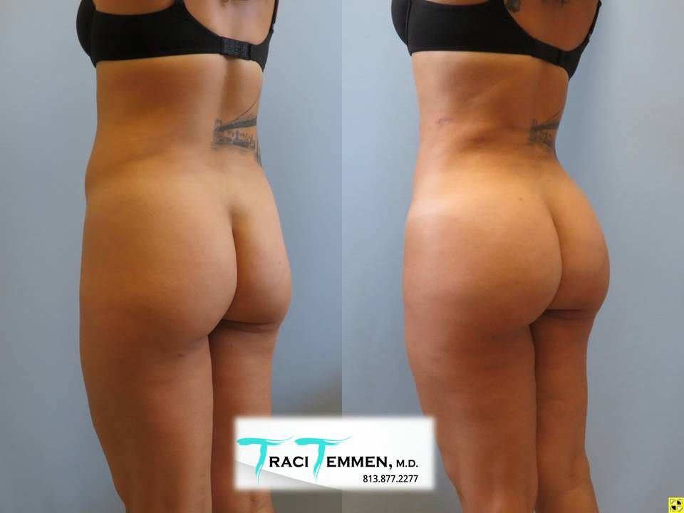 Skinny Brazilian Butt Lift Before & After