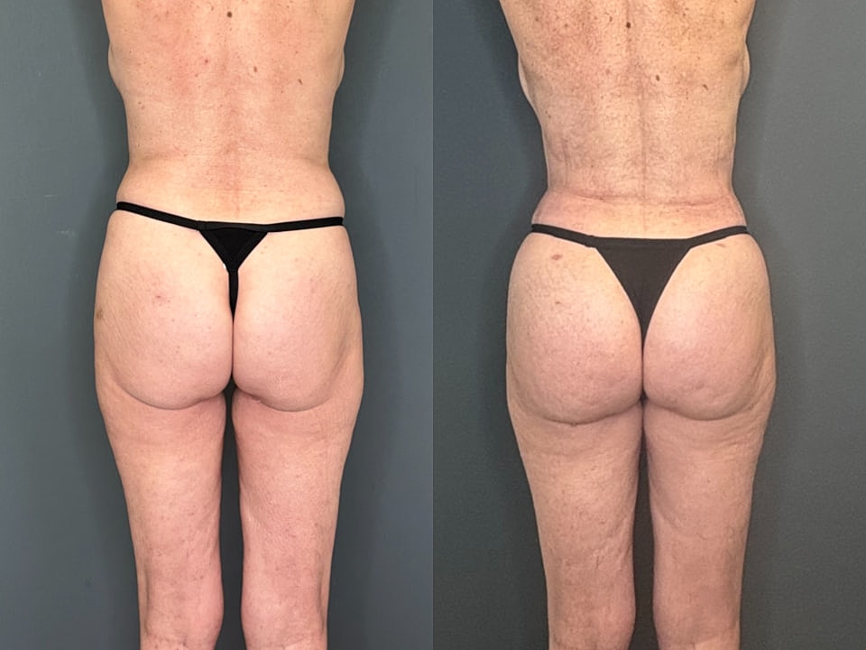 Skinny Brazilian Butt Lift Before & After