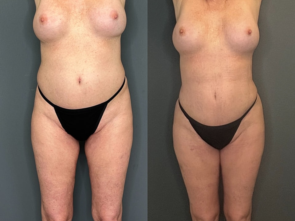 Skinny Brazilian Butt Lift Before & After