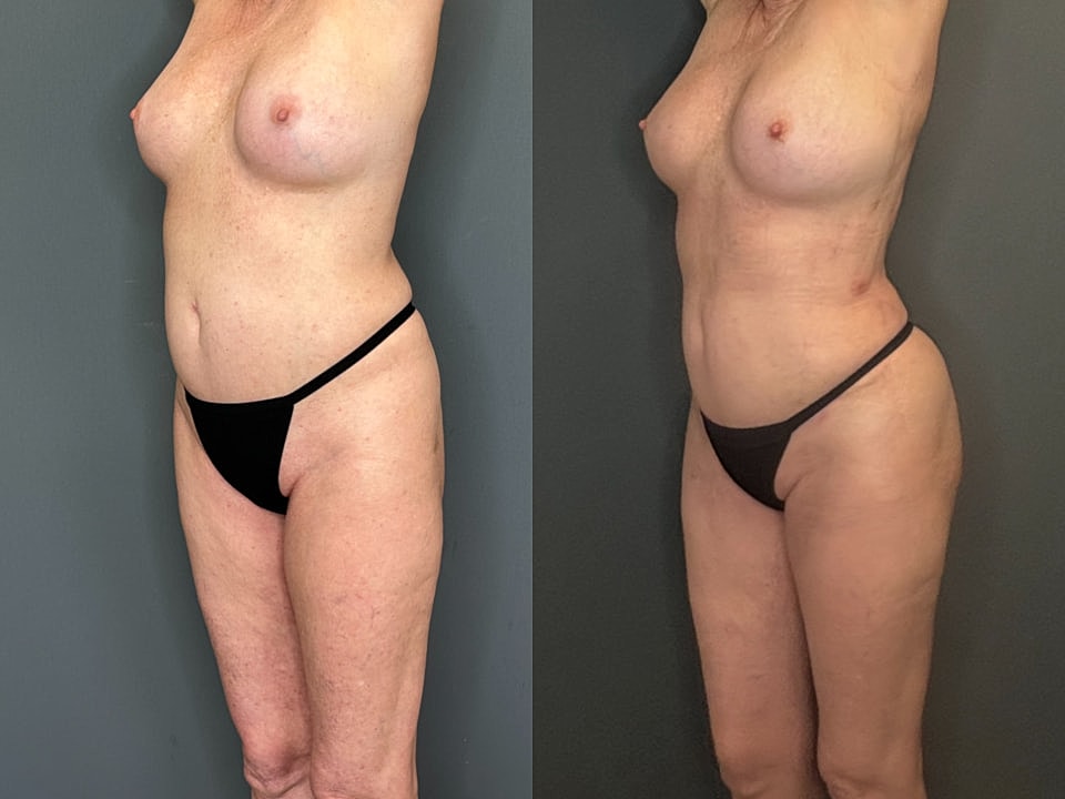 Skinny Brazilian Butt Lift Before & After