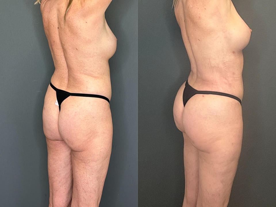 Skinny Brazilian Butt Lift Before & After