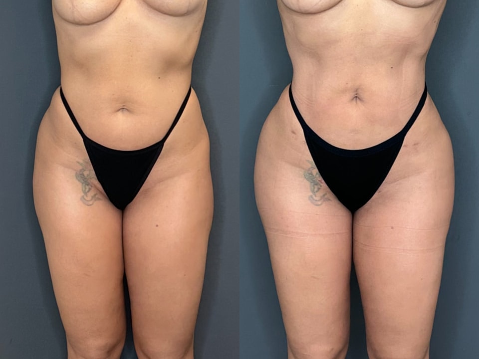 Skinny Brazilian Butt Lift Before & After