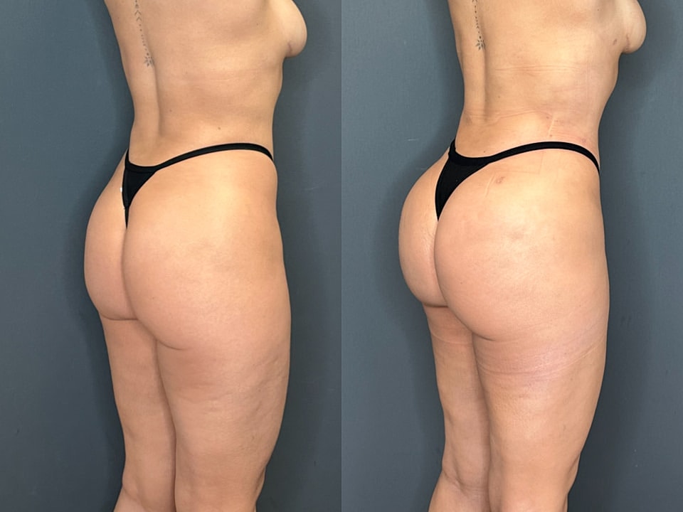 Skinny Brazilian Butt Lift Before & After