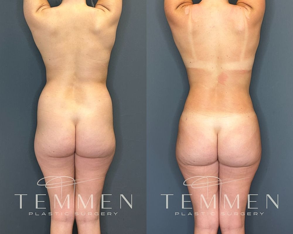 Before and after plastic surgery comparison image.