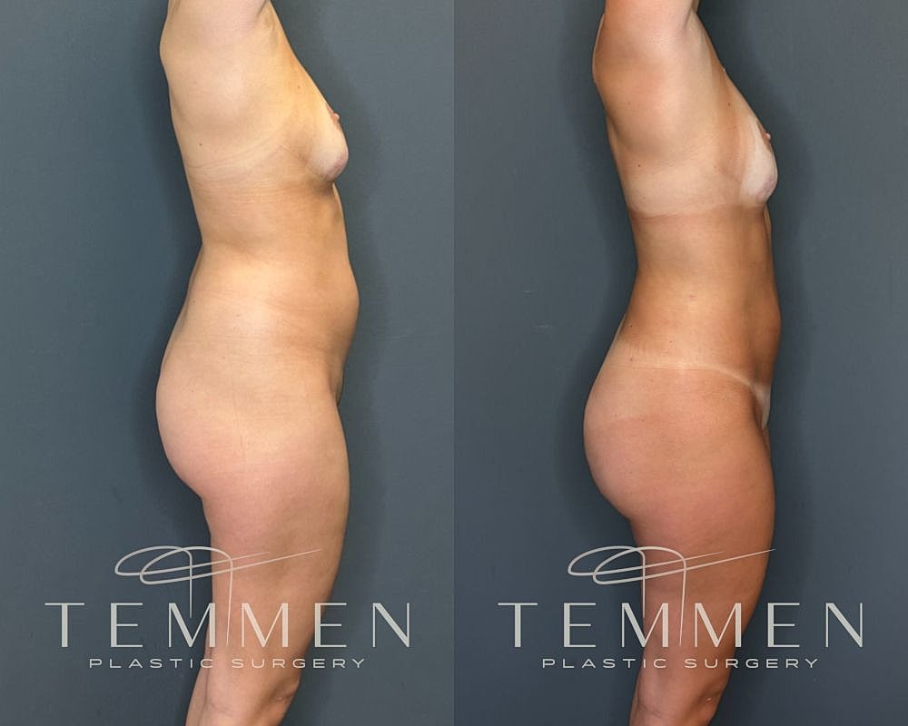 Before and after plastic surgery side profile.