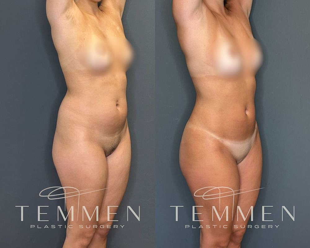 Before and after body contouring results.