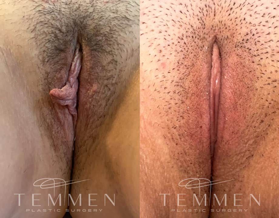 Labiaplasty Before & After