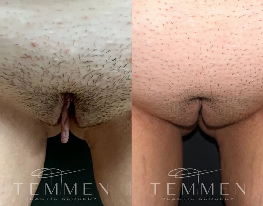 Labiaplasty Before & After