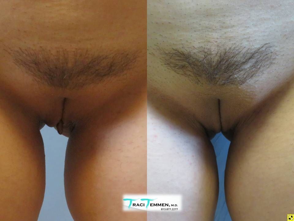 Labiaplasty Before & After