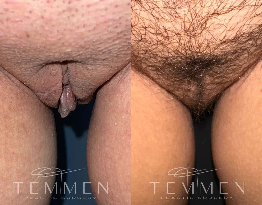 Labiaplasty Before & After
