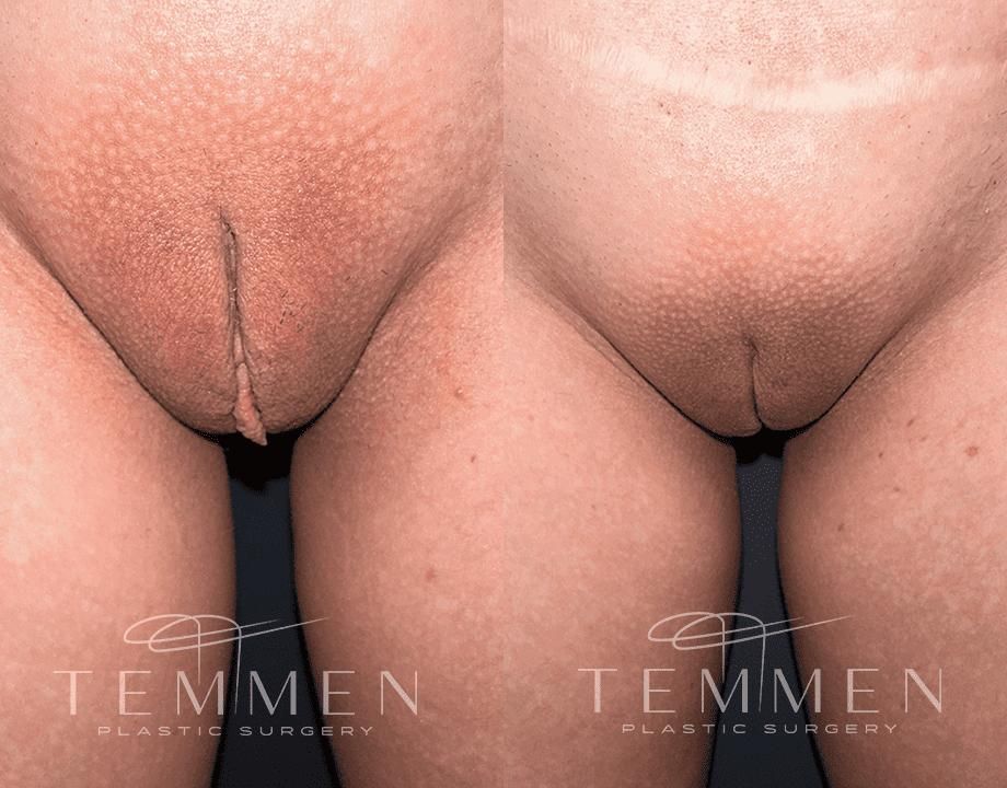 Labiaplasty Before & After