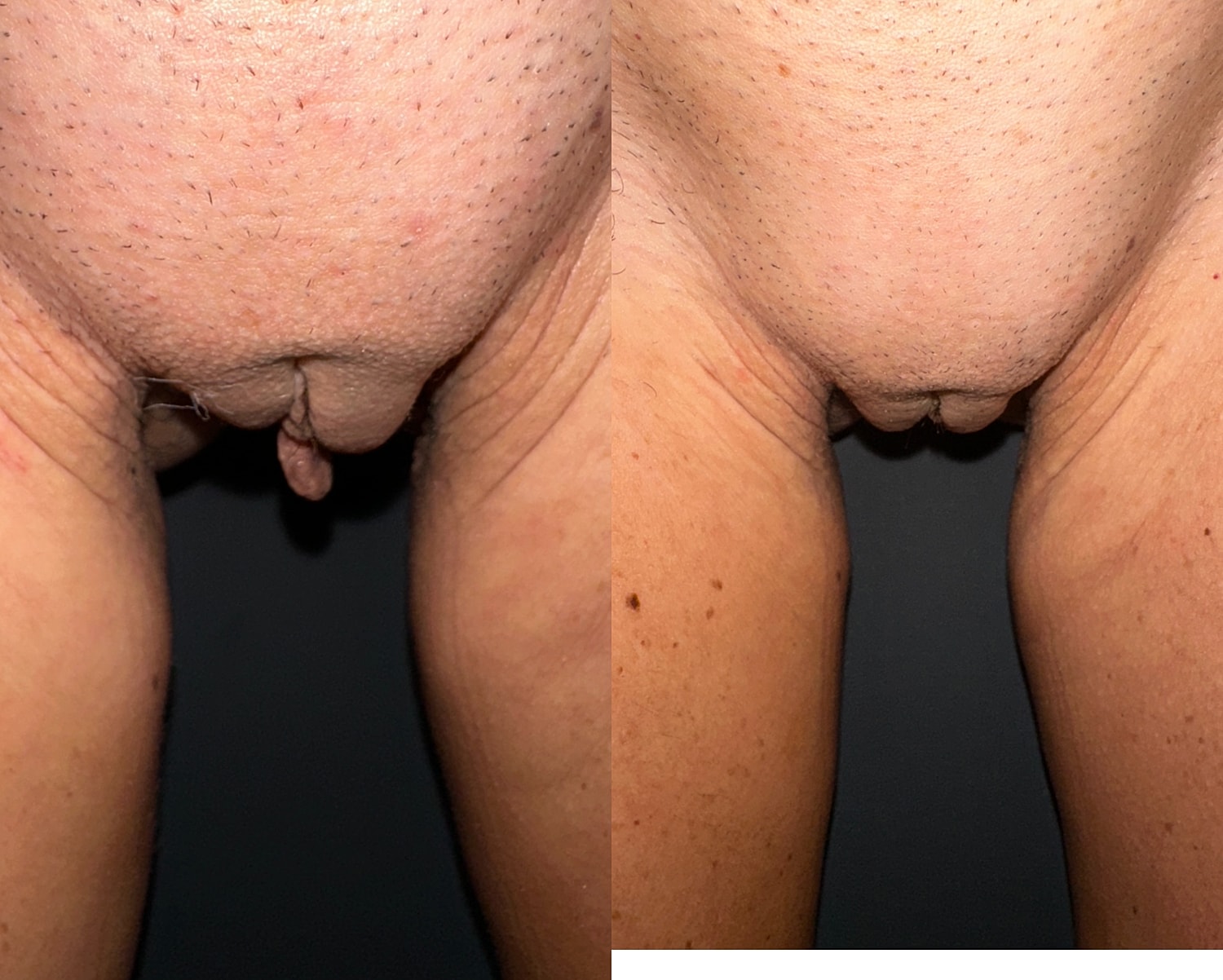 Labiaplasty Before & After