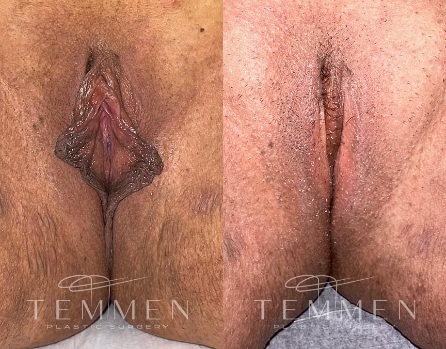 Labiaplasty Before & After