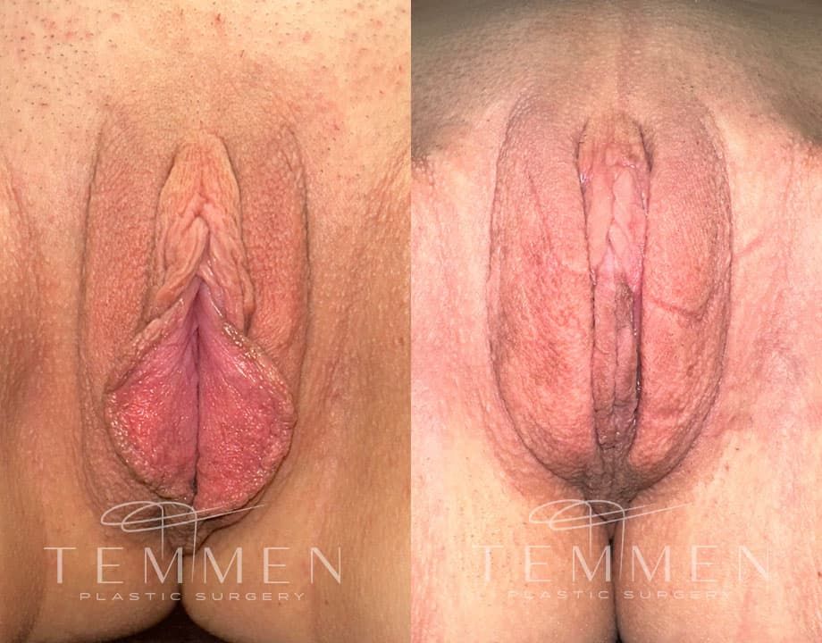 Labiaplasty Before & After