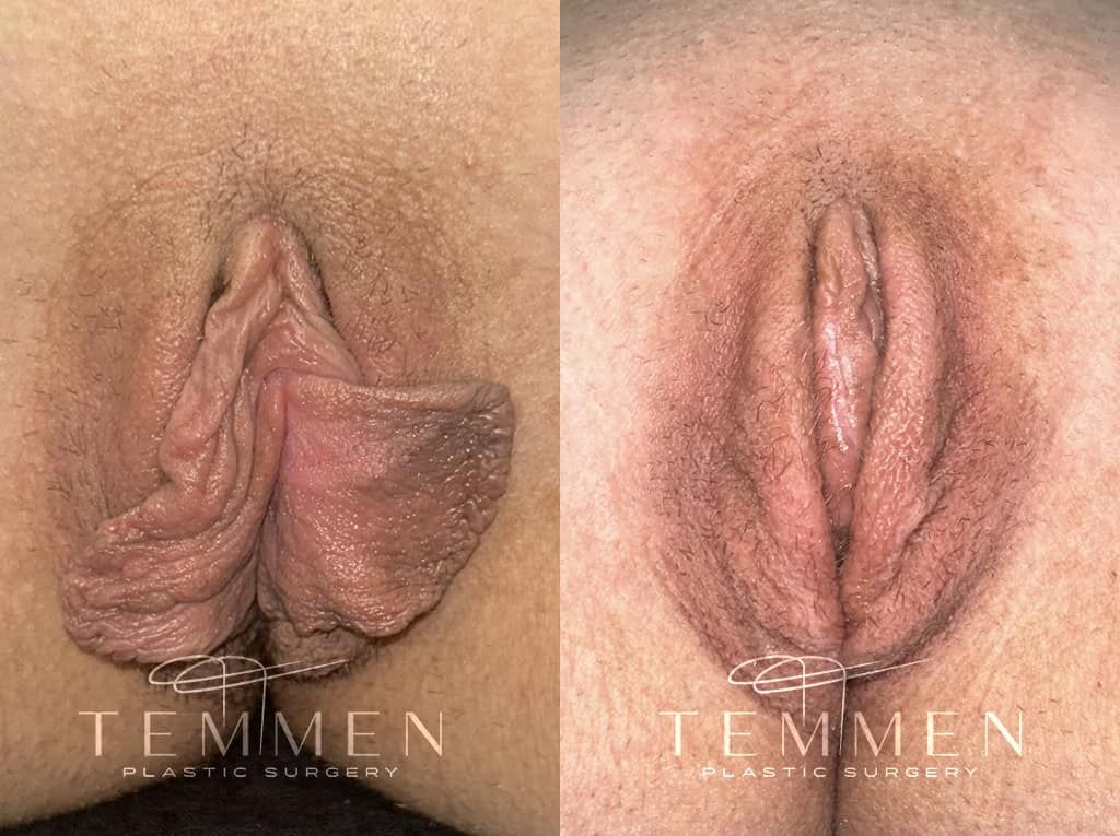 Labiaplasty Before & After