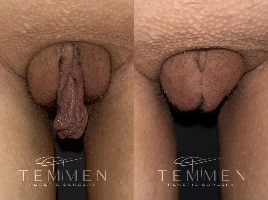Labiaplasty Before & After