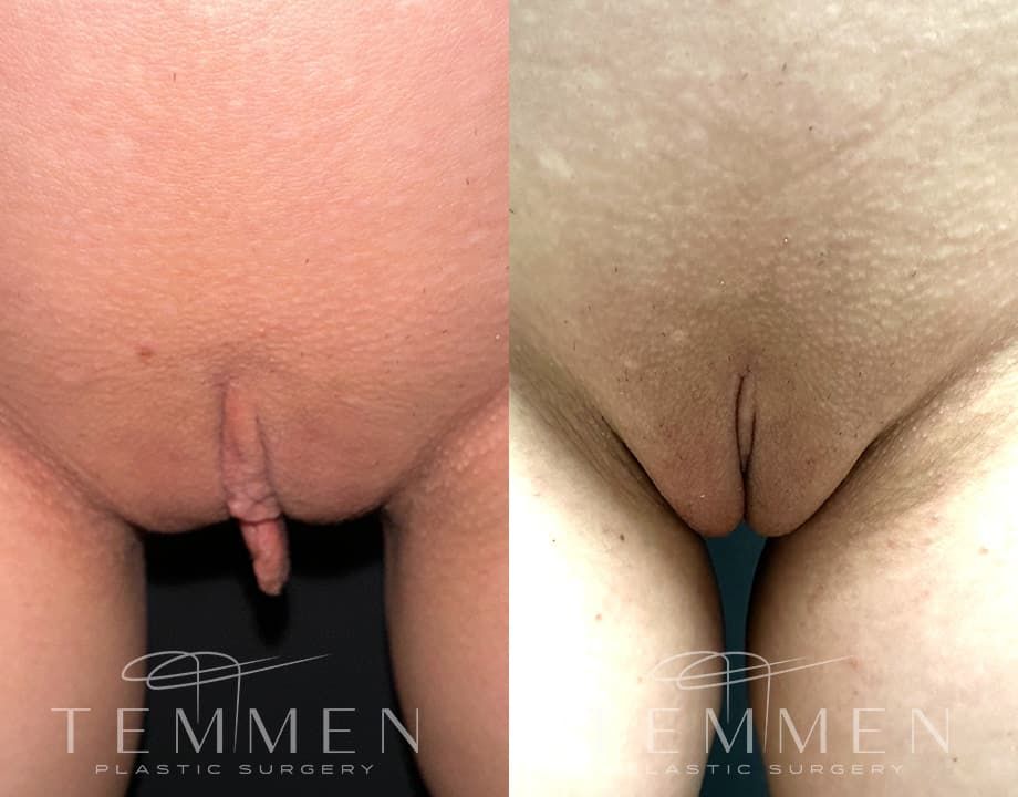 Labiaplasty Before & After