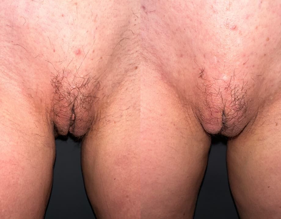 Labiaplasty Before & After