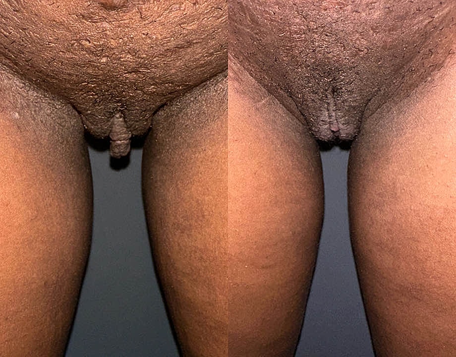 Labiaplasty Before & After