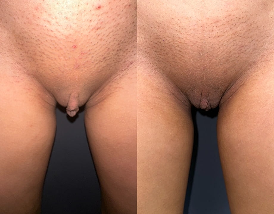 Labiaplasty Before & After