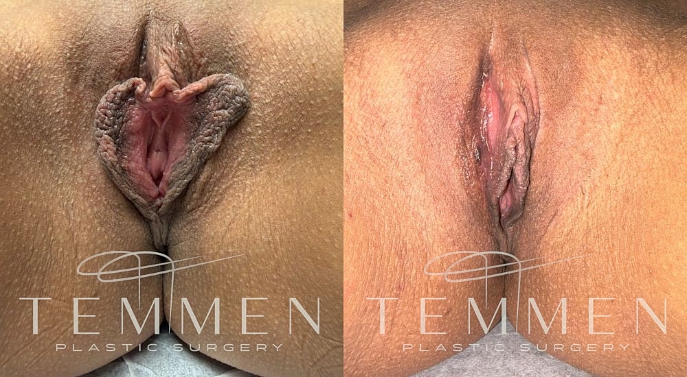 Labiaplasty Before & After
