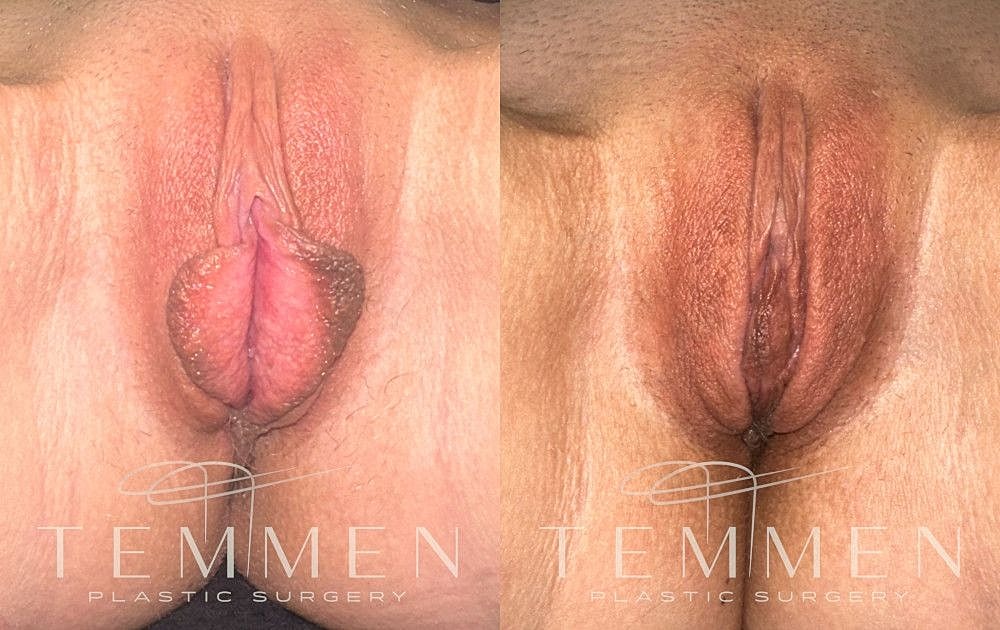 Labiaplasty Before & After