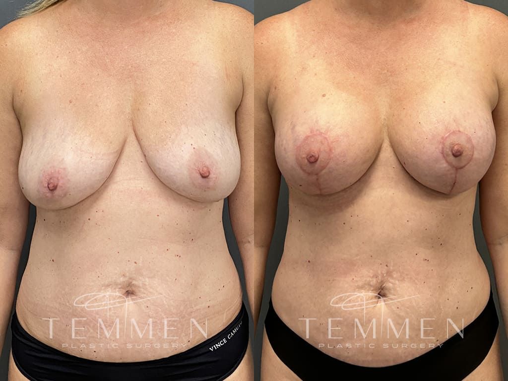 Breast Augmentation With Lift Before & After