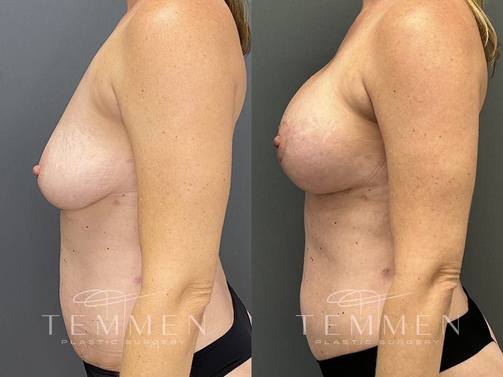 Breast Augmentation With Lift Before & After