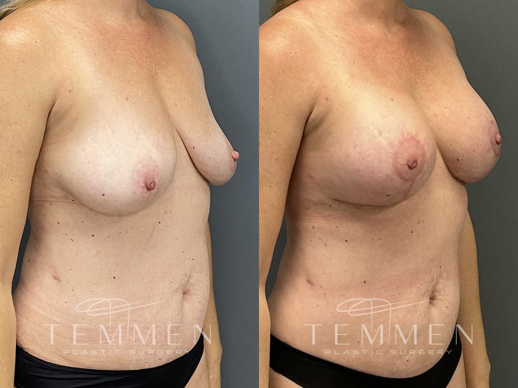 Breast Augmentation With Lift Before & After
